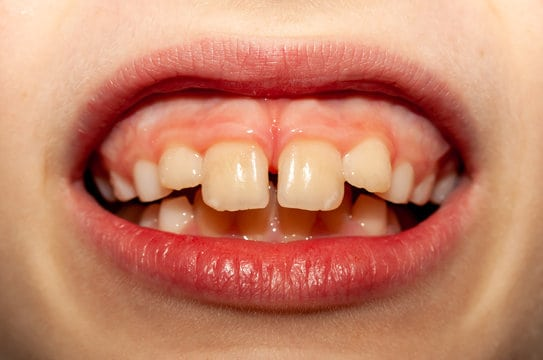 Protruding Teeth Treatment in Dubai