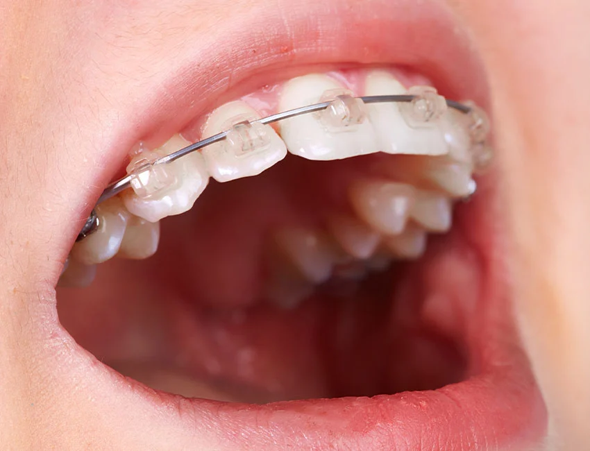 Dentofacial Orthopedics in Dubai