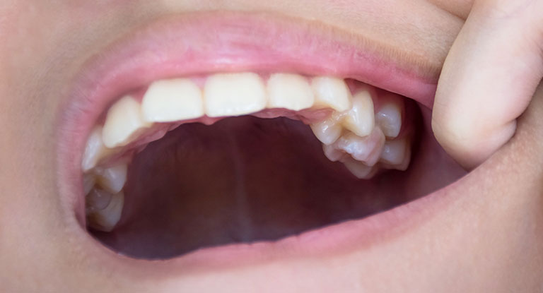 Crowded Teeth Treatment in Dubai