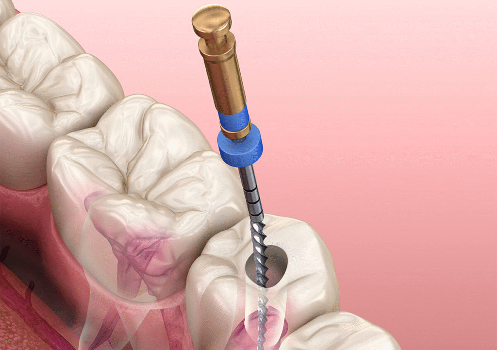 Nerve Filling with Inflammation Treatment