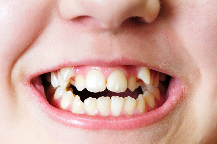 Tooth Growing In What to Do with Extra Teeth: A Complete Guide - Leila Hariri Dental ...