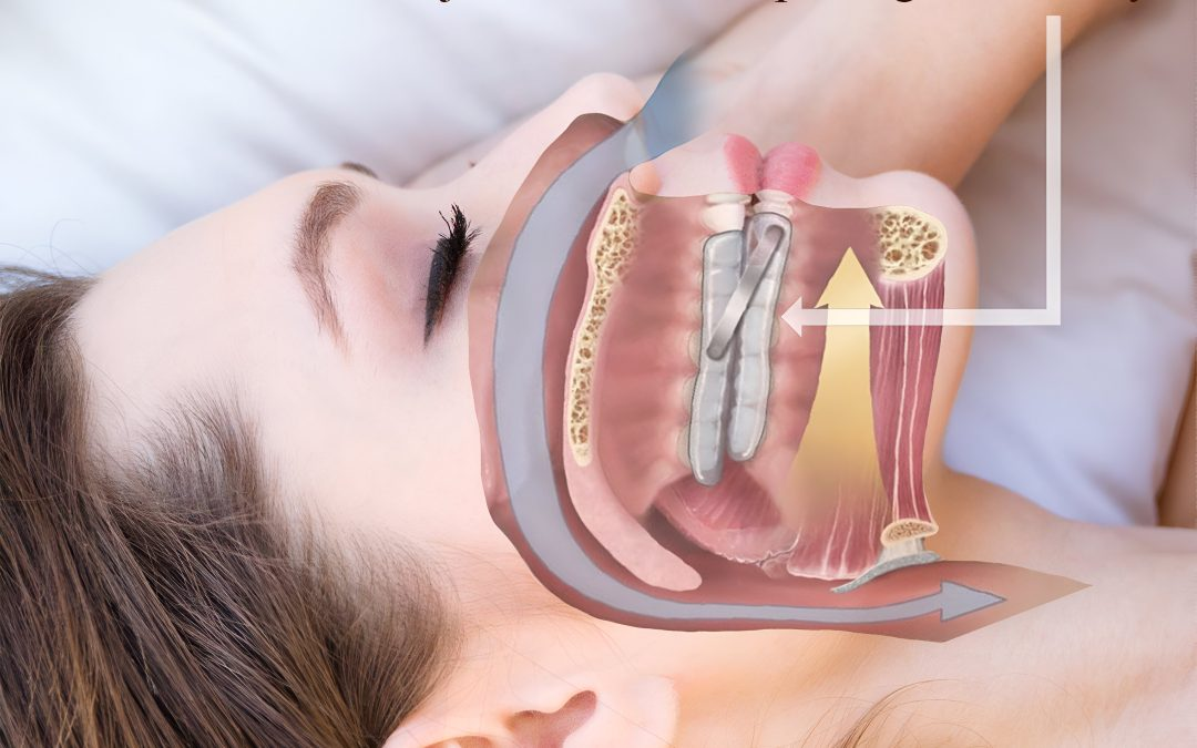 Oral Appliance for Sleep Apnea: 5 Reasons to Try in Dubai